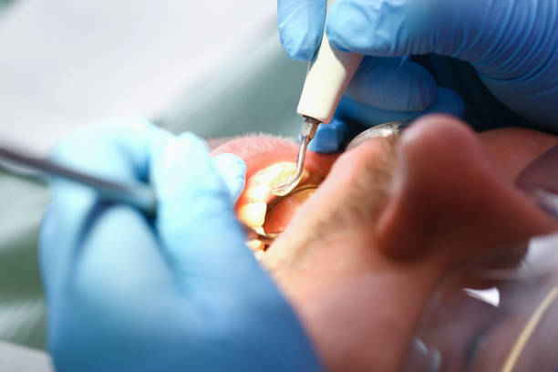 Best Emergency Wisdom Teeth Removal in Wellston, OH