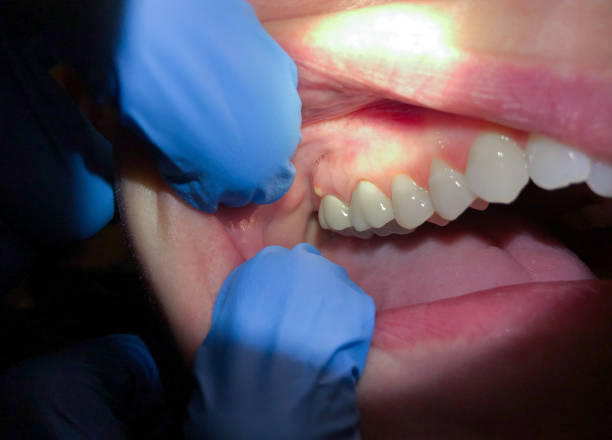 Best Emergency Treatment for Dental Infections or Abscesses in Wellston, OH